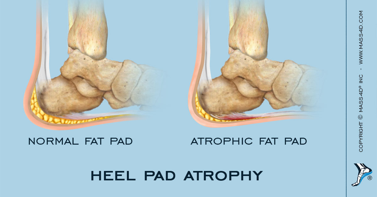 calcaneal fat pad syndrome