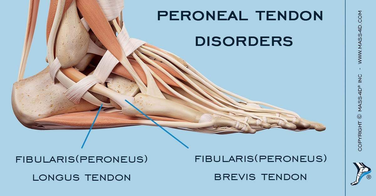 insole for peroneal tendonitis
