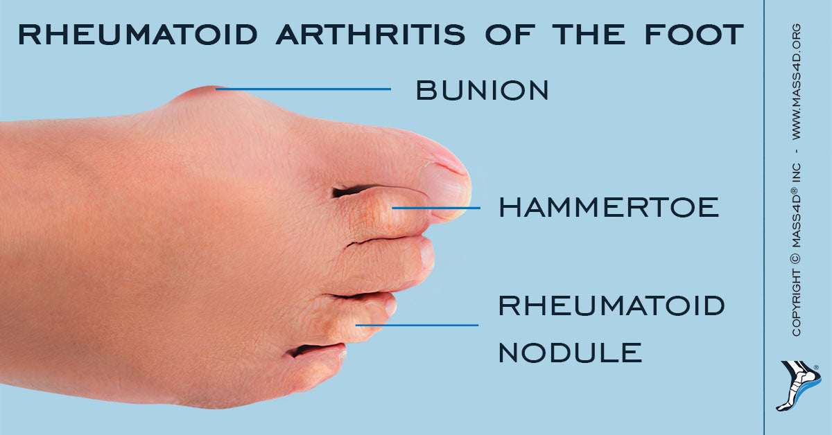 Bunions: A Problem With The Big Toe | MASS4D® Insoles - MASS4D® Foot