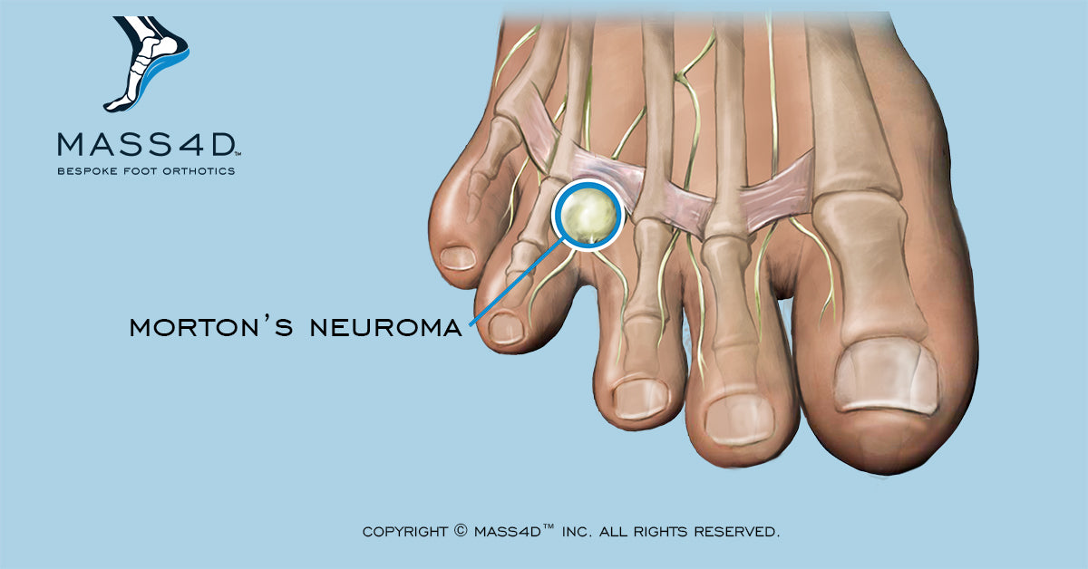morton's neuroma orthotic insoles