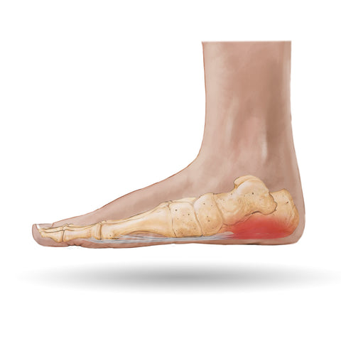 What Is Piriformis Syndrome? - MASS4D® Foot Orthotics