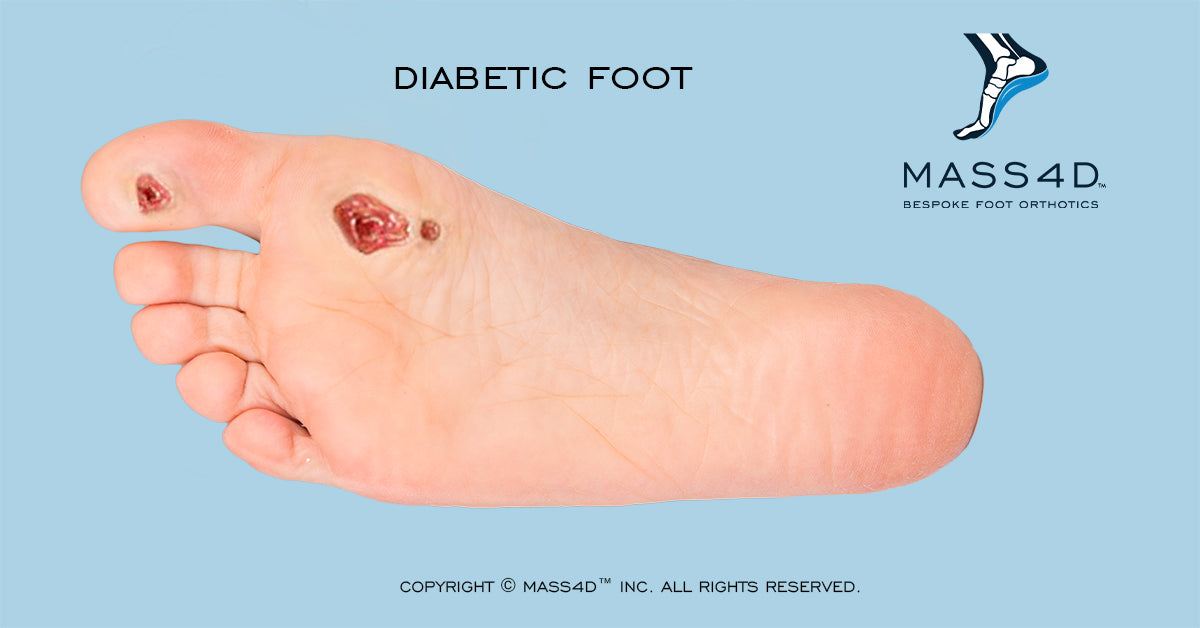 diabetic foot insoles