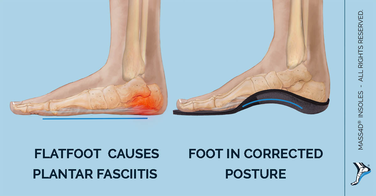 7 Benefits of Using Insoles MASS4D® Foot Orthotics