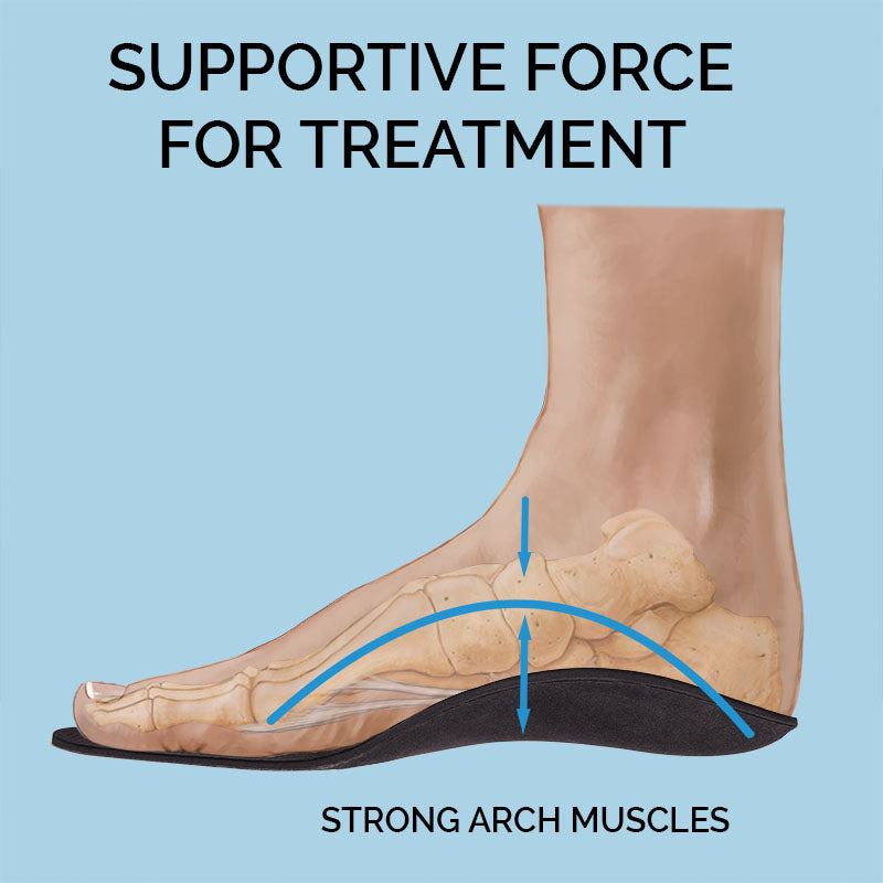 Insoles for High Arches and Supination: 2 Practical Solutions