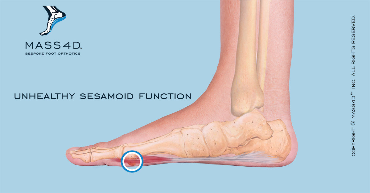 Diagnosis And Treatment Of Sesamoiditis Mass4d® Foot Orthotics