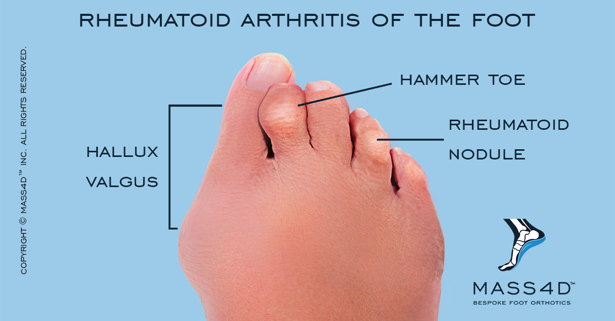 Rheumatoid Arthritis Feet