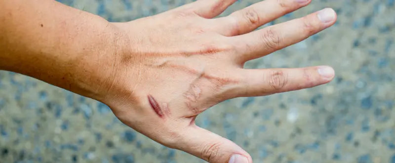 Formation of scars and keloids in the hand