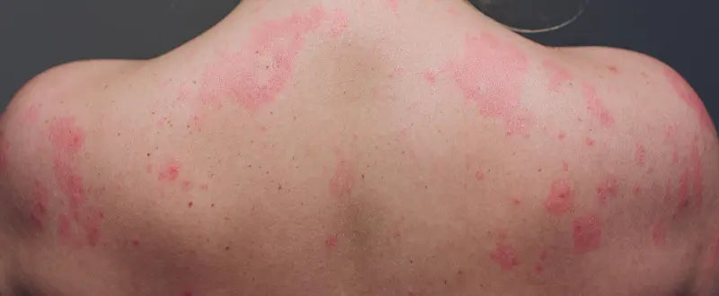 skin infections at the back of the body