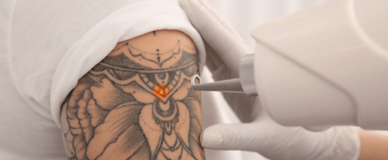 Woman undergoing laser tattoo removal process