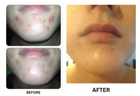 Acne before and after with CocoTherapy