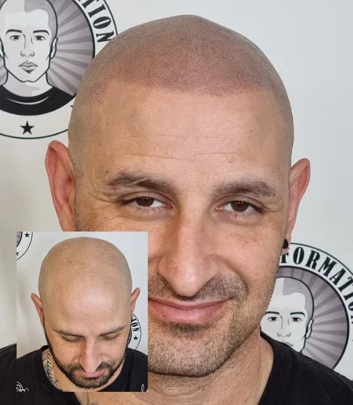 My Transformation, Scalp Micropigmentation Perth, Hair Tattoo Perth, MP Perth, SMP WA, Perth Australia