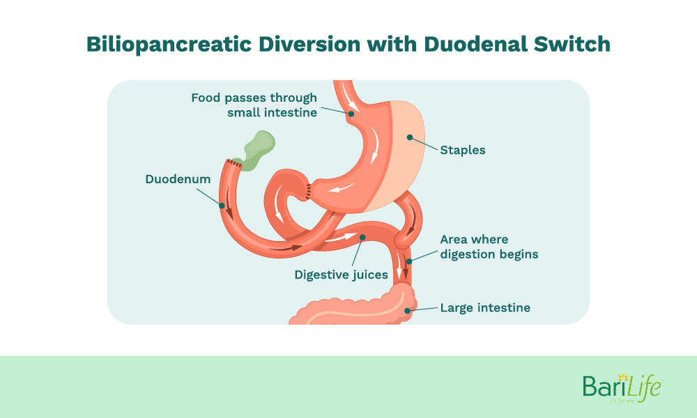 how the duodenal switch works