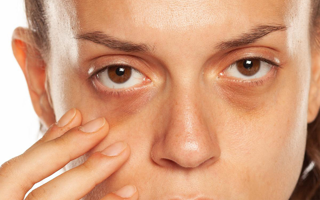 Girl showing her eyebags and dark circles