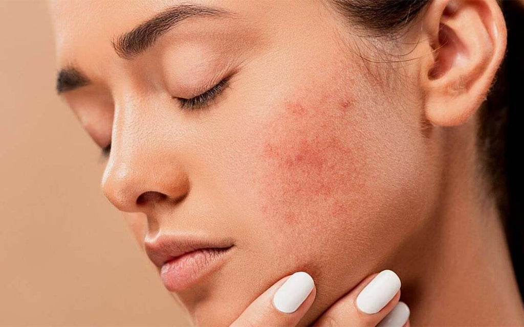 acne prone skin