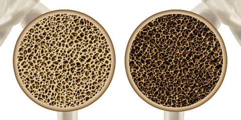 Healthy bone vs osteoporosis