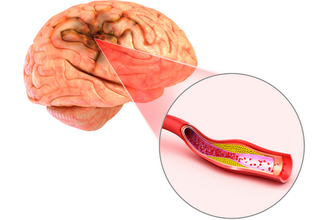 About half of strokes are caused by atherosclerosis