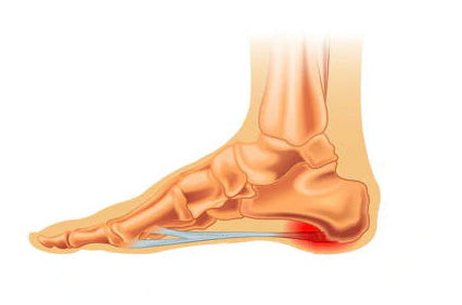 Plantar Fasciitis –