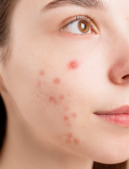 What can be done about acne?