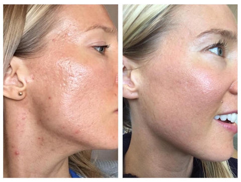 Acne before and after Pure Nilotica Melt and LXMI 33 Face Oil