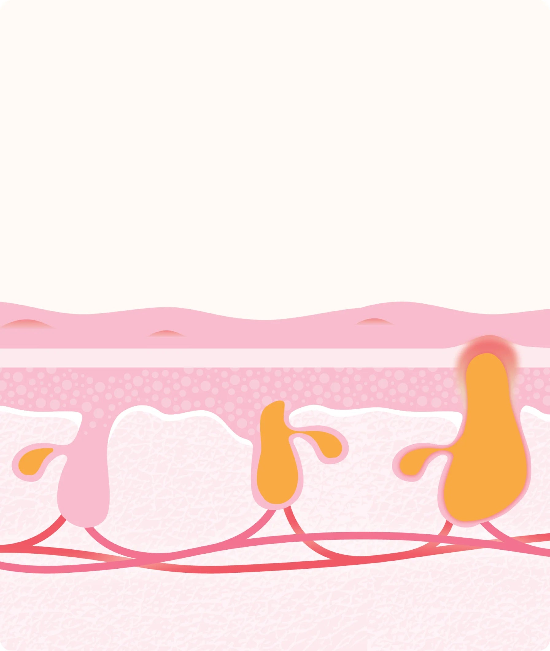 Skin cross-section showing clogged pores