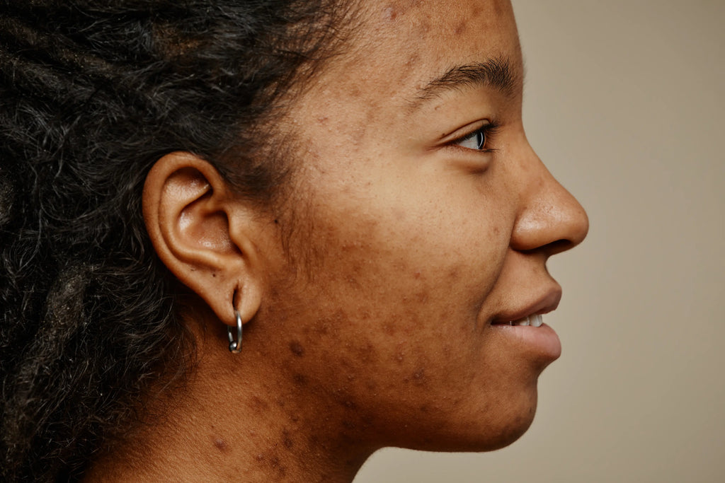 Hyperpigmentation after chemical peel on face