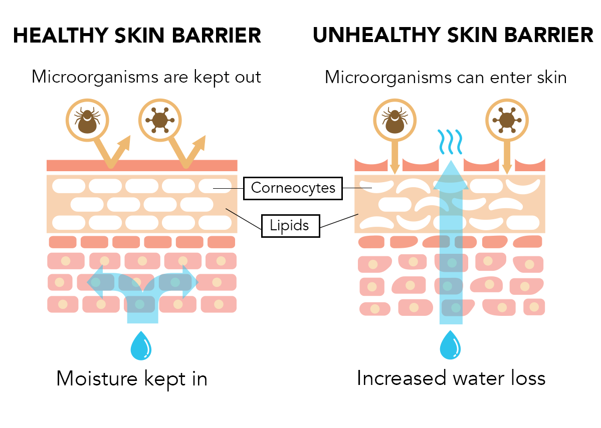 skin barrier performs two very important functions. First, it helps our skin retain moisture by preventing water loss from deeper skin layers. Second, it helps protect our skin from harsh elements like UV rays, pollutants, microbes, and chemicals.
