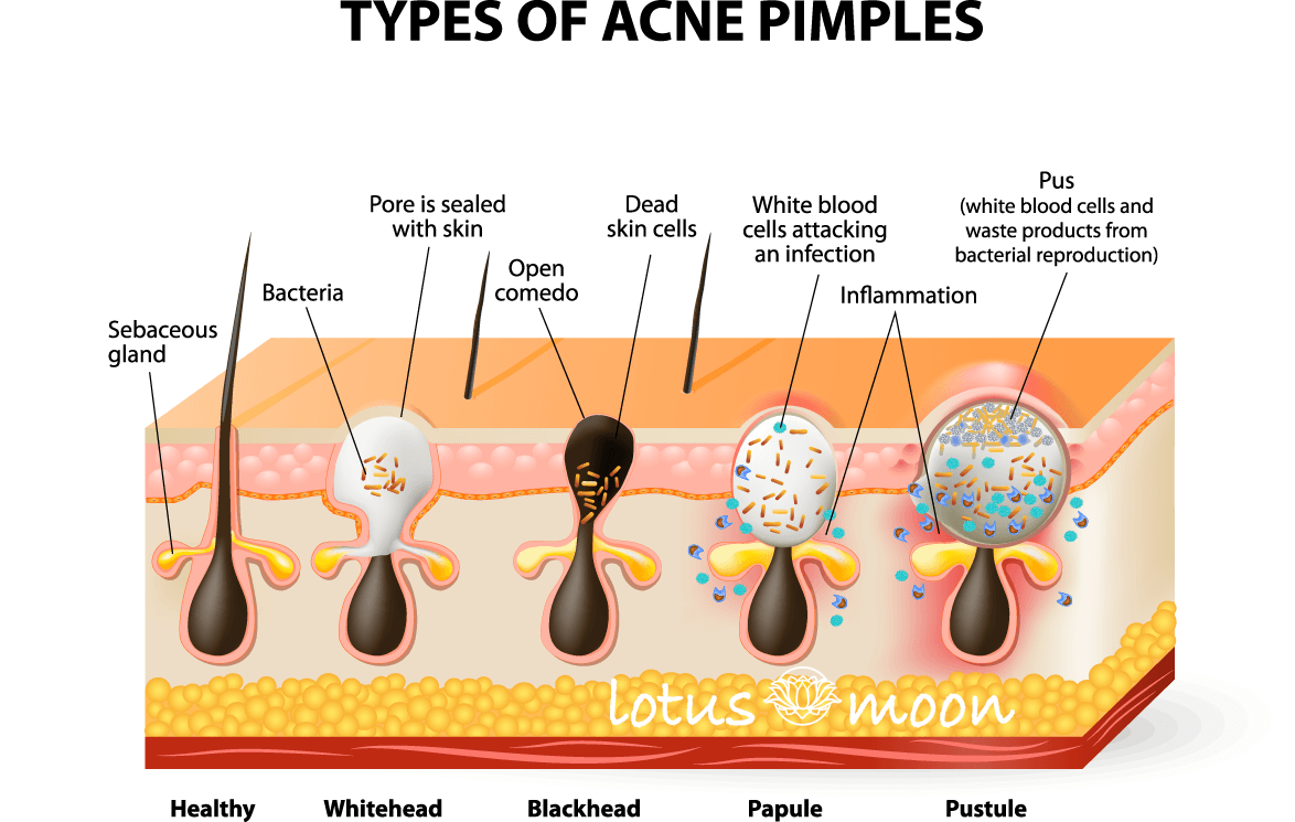 types of acne pimples