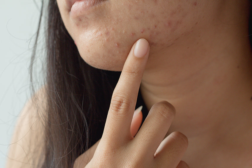 woman with acne blemishes 