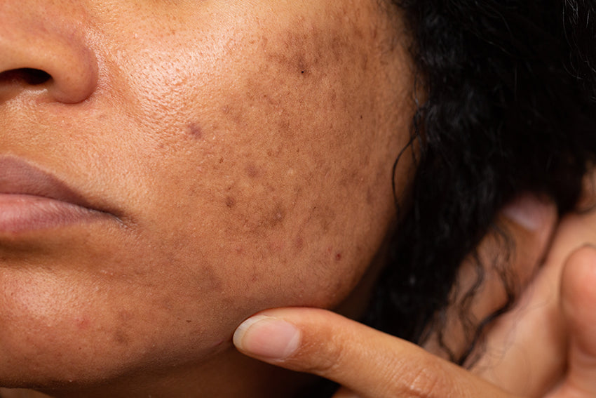 woman with dark spots or hyperpigmentation 