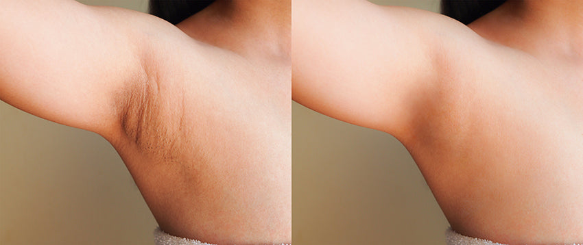 dark underarms: before and after