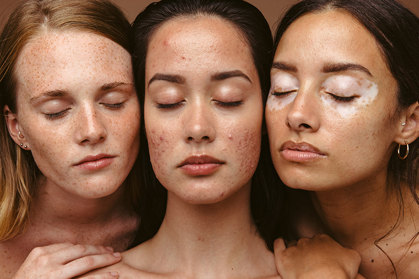 Women with acne