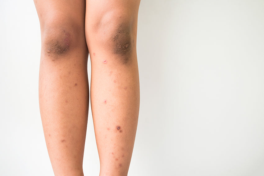 legs with hyperpigmentation