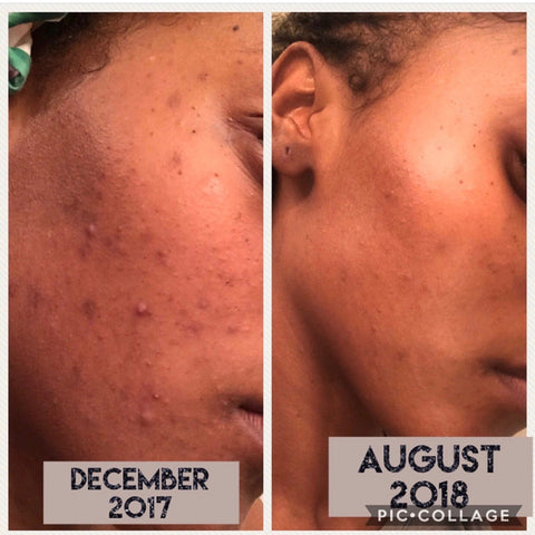 Before and After side profile images of a young African American woman suffering from acne and hyperpigmentation 