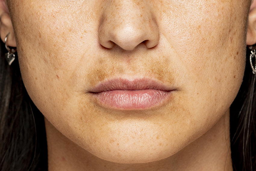 woman with dark spots and uneven skin tone around her lips 