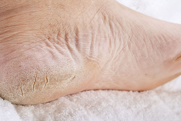 foot soak for hard skin on feet