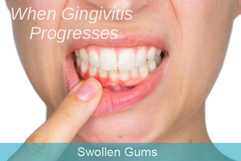 gingivitis