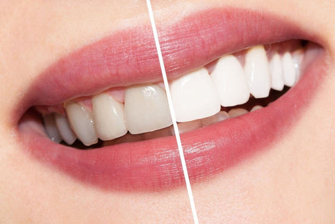 Before and after photo showing AP24 teeth whitening with no flouride