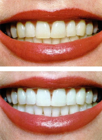 Before and After Photo Teeth Whitening Toothpaste