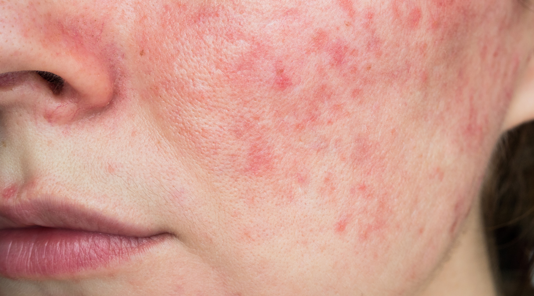 The image shows the side of the face and a red rash that is lots of little spots and inflamed skin that looks like Rosacea