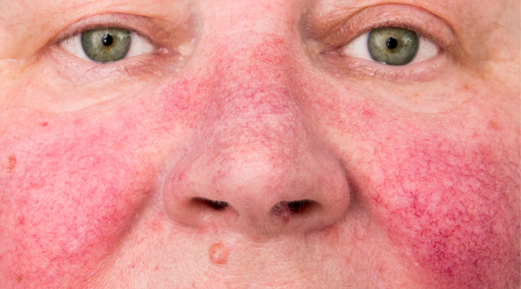 Middle aged women with broken capillaries across cheeks