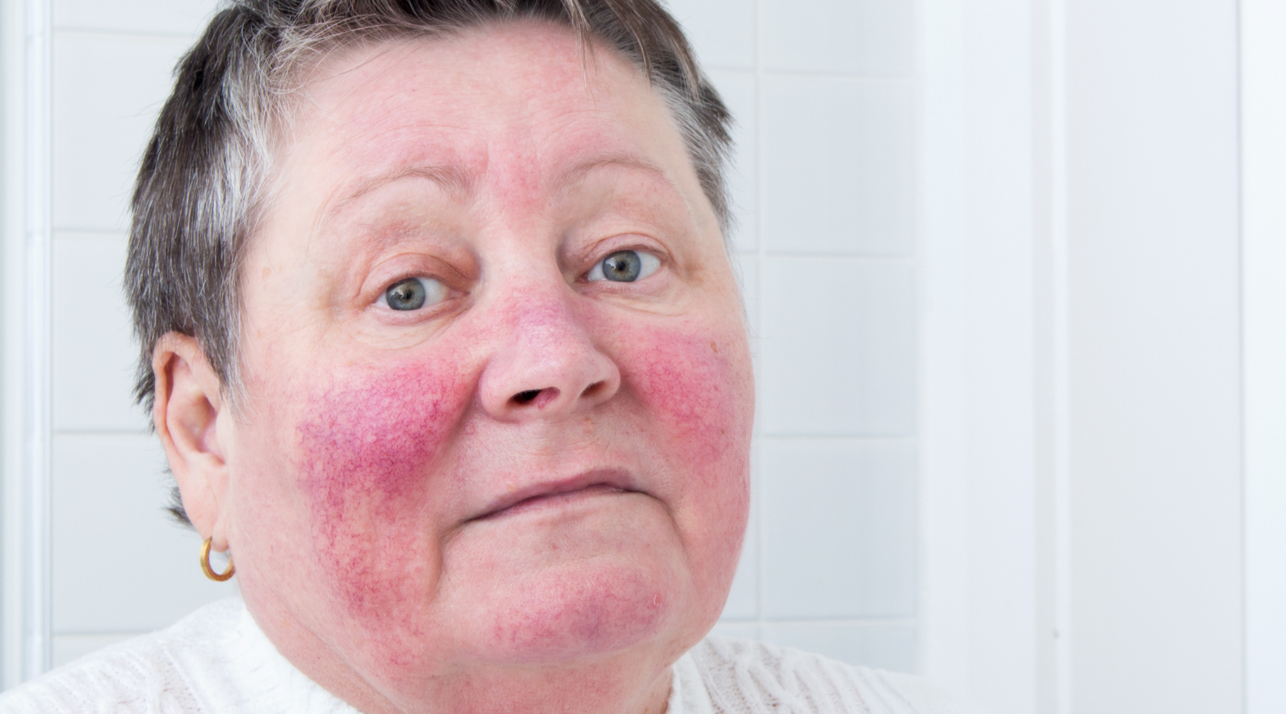 Middle aged woman with Rosacea