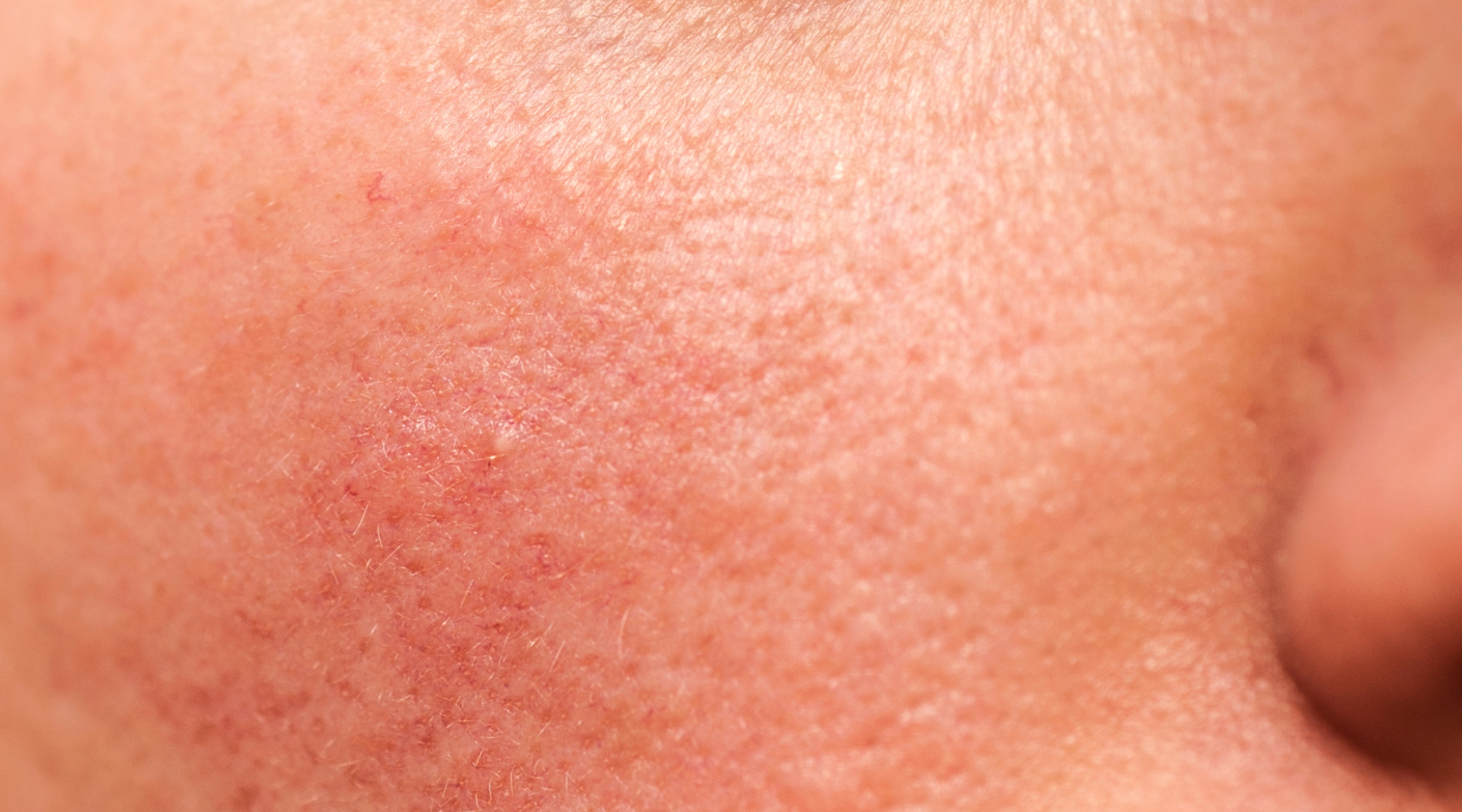 Closeup of sensitised skin with a rash