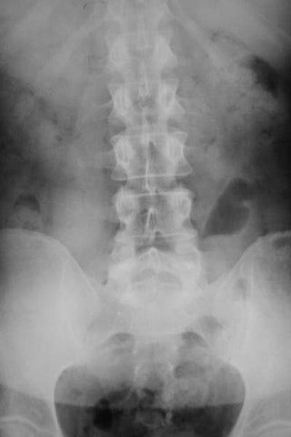 back-xray