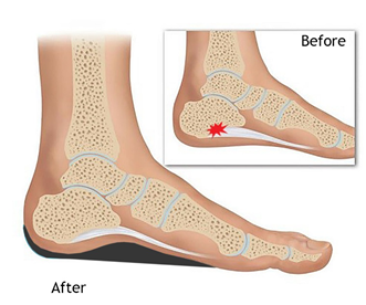 insoles for heel pain