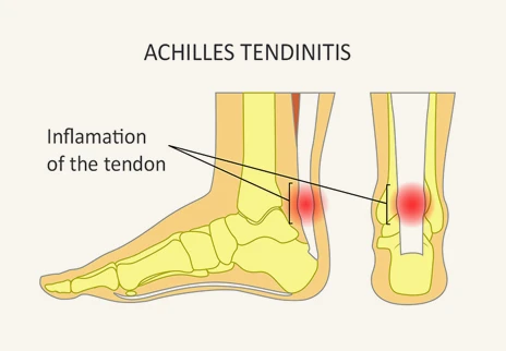 Achilles Tendonitis Shoes, Symptoms & Treatment | OrthoFeet