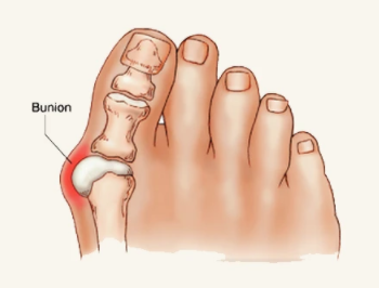 How to Prevent Bunions From Getting Worse
