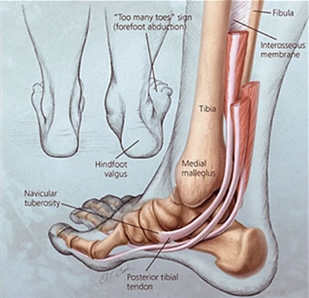 sole for flat feet