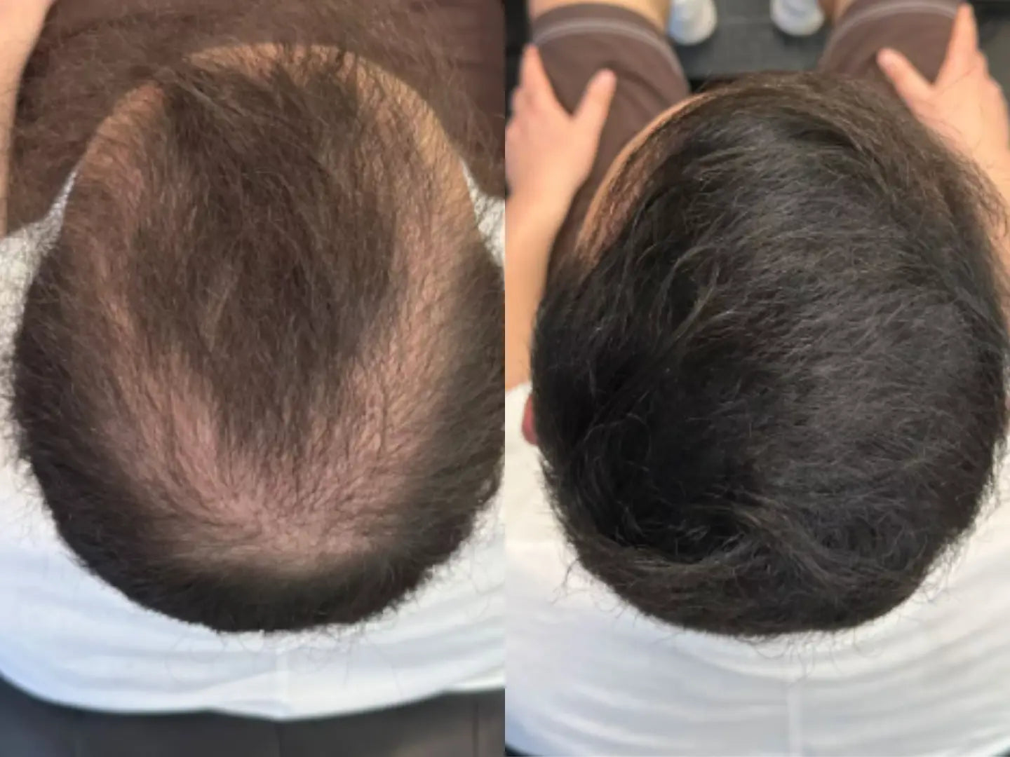 Dekker tynnere parti på kronen med Eterna