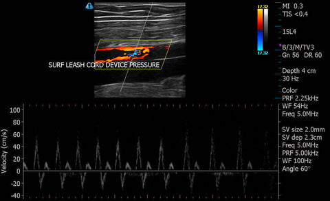 Improvised Tourniquet Doppler Ultrasound  from Surfboard Leash / Leg Rope