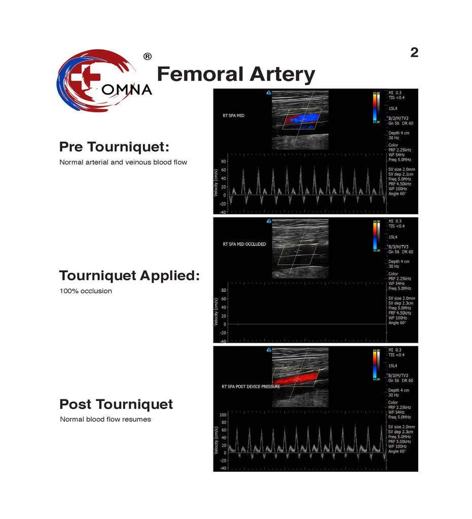 OMNA Tourniquet Surfboard Leash Femoral Arterial Occlusion